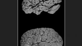 Alzheimer’s Disease: Cognitive Decline Prominent Indicator of Life Expectancy