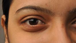 Eye Bank