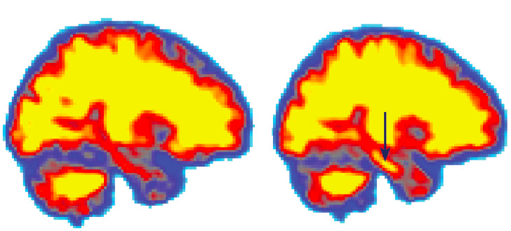 Regular, Good Quality Sleep Could Be a Way to Prevent Alzheimer’s 