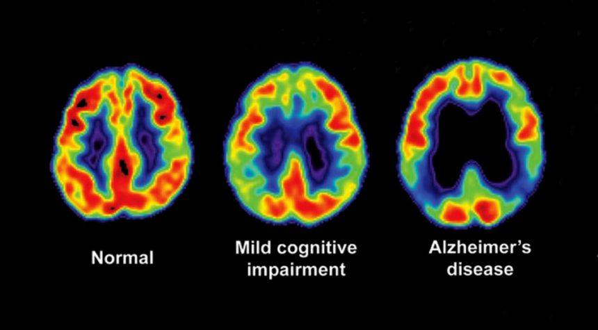 Alzheimer's disease can be a result of lethal proteins known as prions.