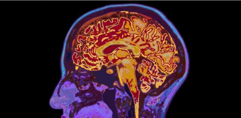 How Dementia Spreads Through Brain